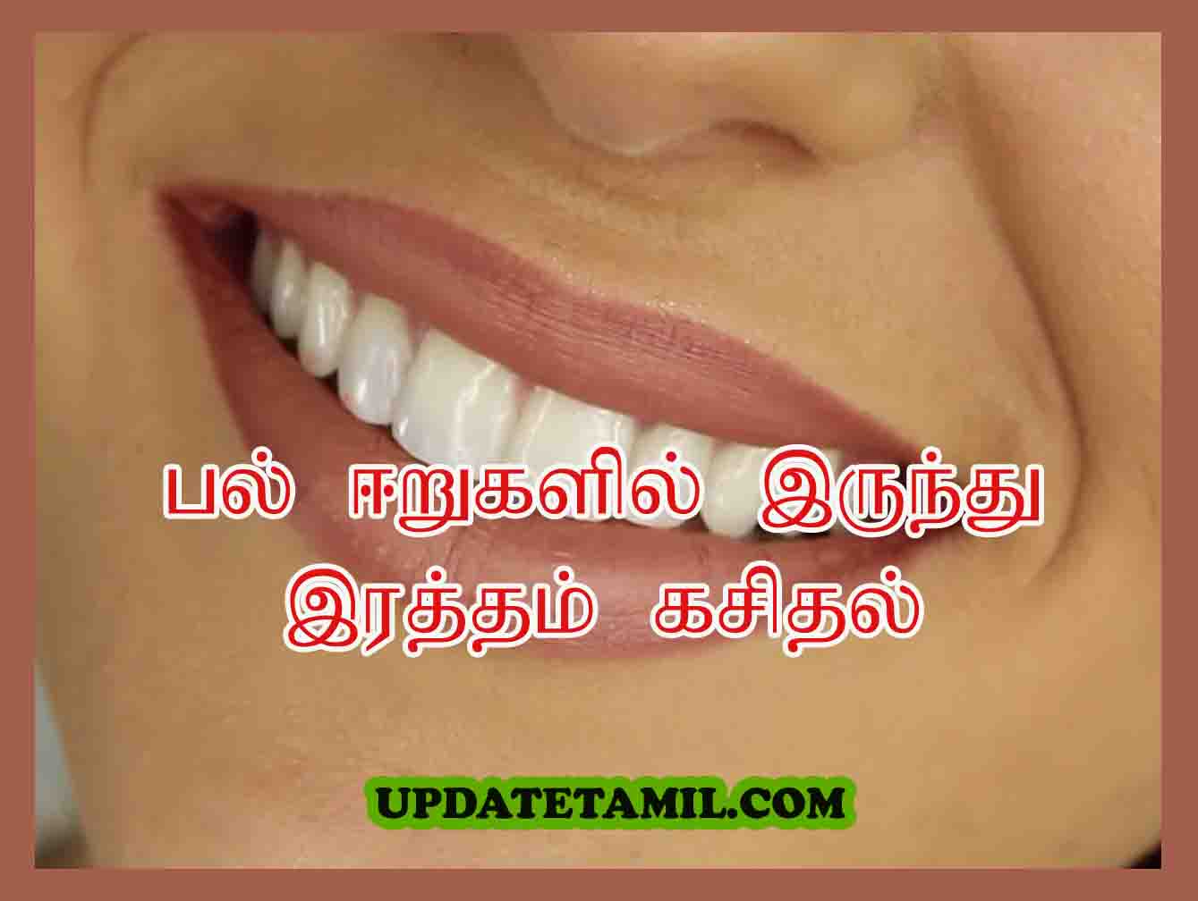 பல் ஈறுகளில் இருந்து இரத்தம் கசிதல் | Teeth Health Tips in Tamil