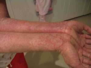 skin allergy in tamil