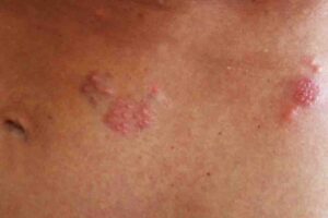 skin allergy treatment in tamil