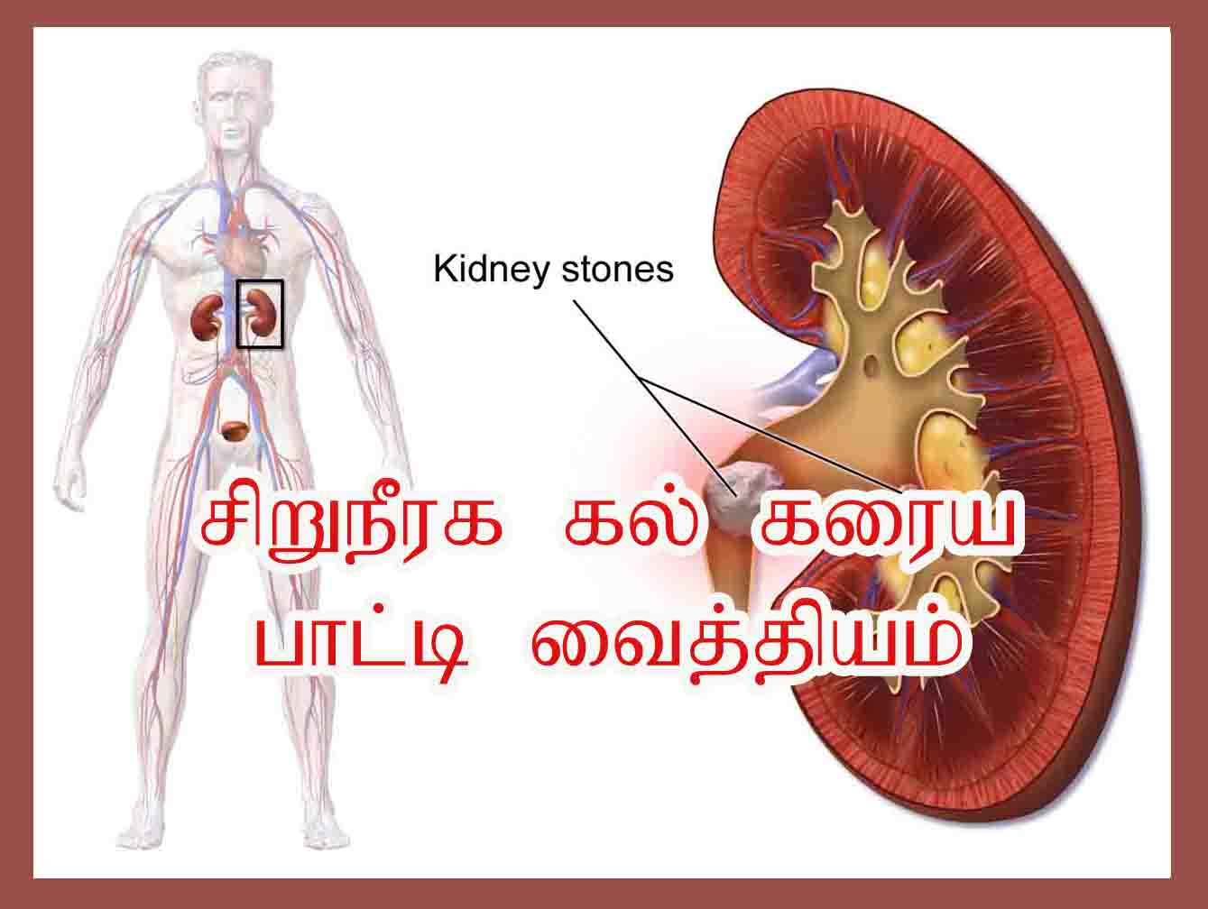 சிறுநீரக கல் கரைய பாட்டி வைத்தியம் | Kidney Stone Treatment in Tamil