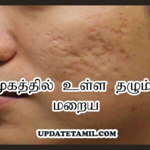 முகத்தில் உள்ள தழும்பு மறைய Thalumbu Remove Cream