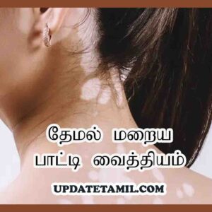 தேமல் மறைய பாட்டி வைத்தியம்